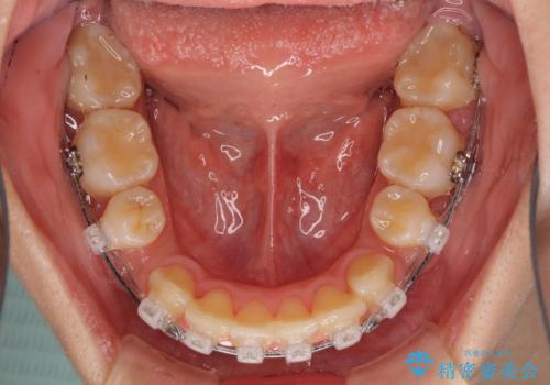 部分矯正で出っ歯になった 出っ歯改善の抜歯矯正の治療中