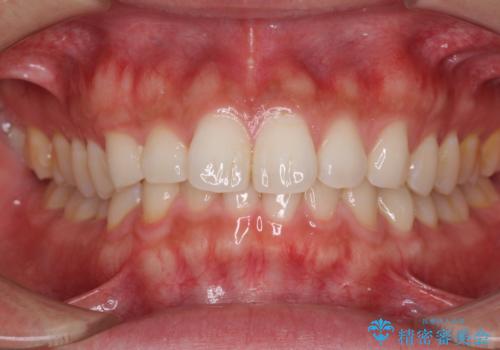 細かい隙間にものがはさまる インビザラインによる矯正治療の症例 治療前
