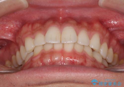 細かい隙間にものがはさまる インビザラインによる矯正治療の治療前