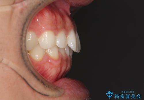 細かい隙間にものがはさまる インビザラインによる矯正治療の治療前