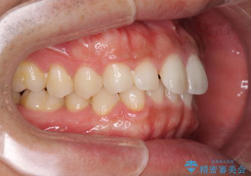 細かい隙間にものがはさまる インビザラインによる矯正治療の治療前