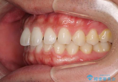 細かい隙間にものがはさまる インビザラインによる矯正治療の治療前