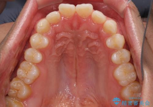細かい隙間にものがはさまる インビザラインによる矯正治療の治療前