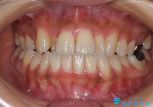 【モニター】幅の狭い上顎歯列 骨幅を拡大する矯正治療の症例 治療前