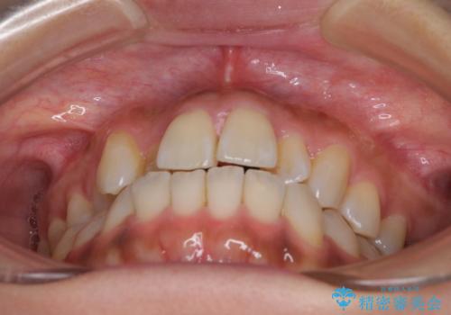 【モニター】幅の狭い上顎歯列 骨幅を拡大する矯正治療の治療前