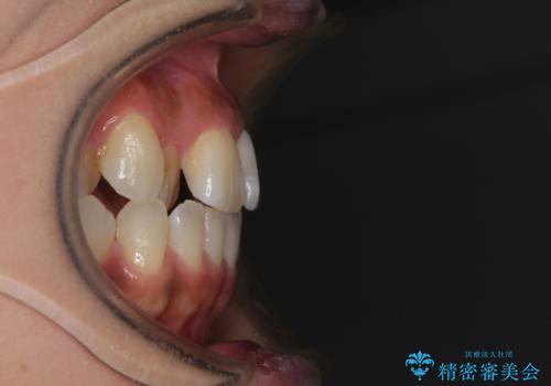 【モニター】幅の狭い上顎歯列　骨幅を拡大する矯正治療の治療前