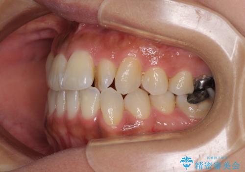 【モニター】幅の狭い上顎歯列 骨幅を拡大する矯正治療の治療前