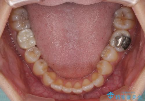 【モニター】幅の狭い上顎歯列　骨幅を拡大する矯正治療の治療前
