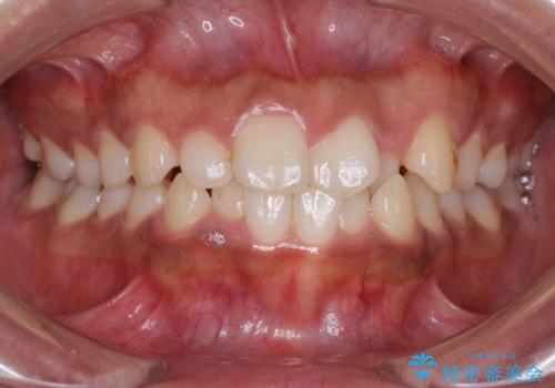 インビザラインが続けられない ワイヤー装置での矯正治療の症例 治療前