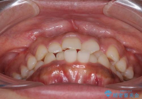 インビザラインが続けられない ワイヤー装置での矯正治療の治療前