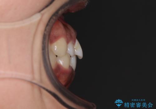 インビザラインが続けられない ワイヤー装置での矯正治療の治療前