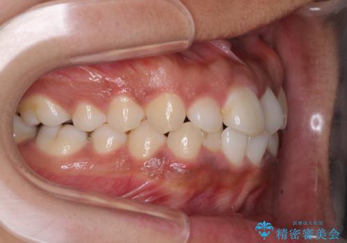 インビザラインが続けられない ワイヤー装置での矯正治療の治療前