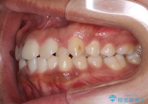 インビザラインが続けられない ワイヤー装置での矯正治療の治療前