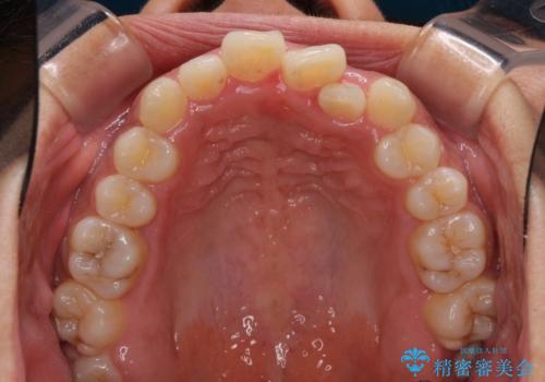 インビザラインが続けられない ワイヤー装置での矯正治療の治療前