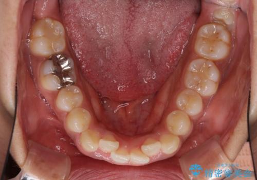 インビザラインが続けられない ワイヤー装置での矯正治療の治療前