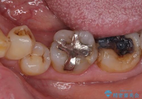 銀歯や虫歯を治したい ゴールドインレーによるむし歯治療の治療前