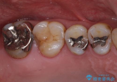 銀歯や虫歯を治したい　ゴールドインレーによるむし歯治療の症例 治療前