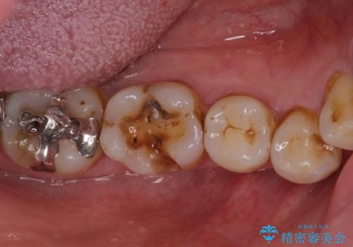 銀歯や虫歯を治したい ゴールドインレーによるむし歯治療の治療前