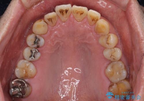 銀歯や虫歯を治したい ゴールドインレーによるむし歯治療の治療前