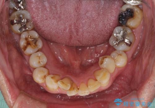 銀歯や虫歯を治したい ゴールドインレーによるむし歯治療の治療前