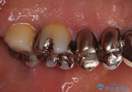 歯肉が腫れて出血する 奥歯の歯周病治療の治療前