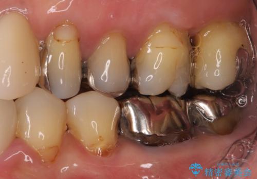 歯肉が腫れて出血する　奥歯の歯周病治療の治療前