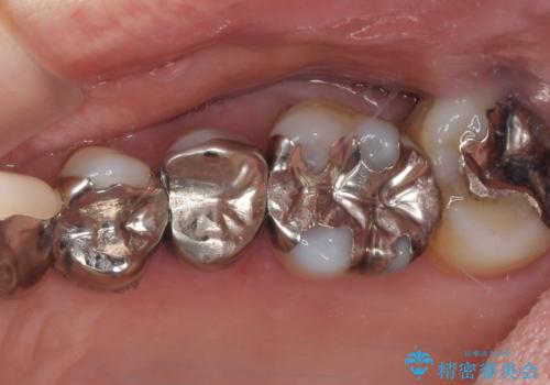 歯肉が腫れて出血する　奥歯の歯周病治療の症例 治療前