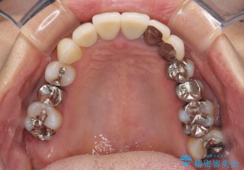 歯肉が腫れて出血する 奥歯の歯周病治療の治療前