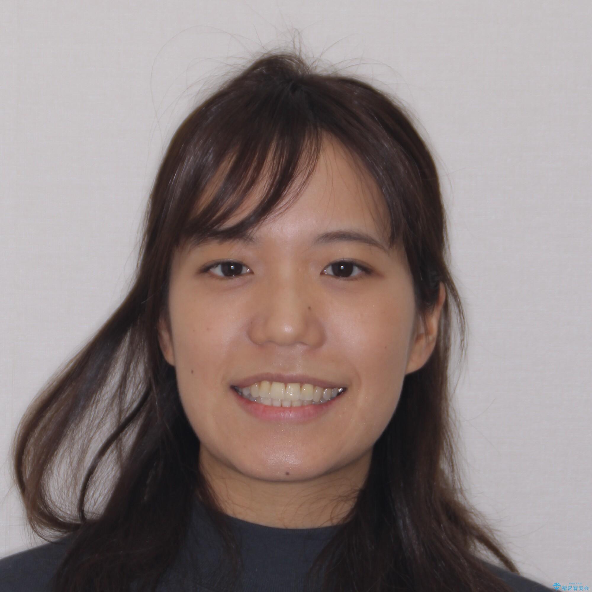 【モニター】幅の狭い上顎歯列 骨幅を拡大する矯正治療の治療後(顔貌)