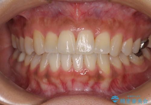 【モニター】幅の狭い上顎歯列 骨幅を拡大する矯正治療の症例 治療後