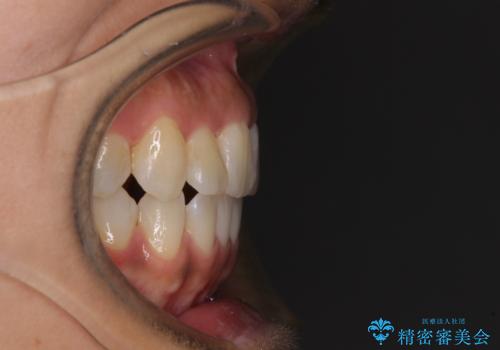 【モニター】幅の狭い上顎歯列　骨幅を拡大する矯正治療の治療後