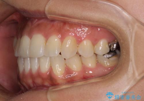 【モニター】幅の狭い上顎歯列 骨幅を拡大する矯正治療の治療後