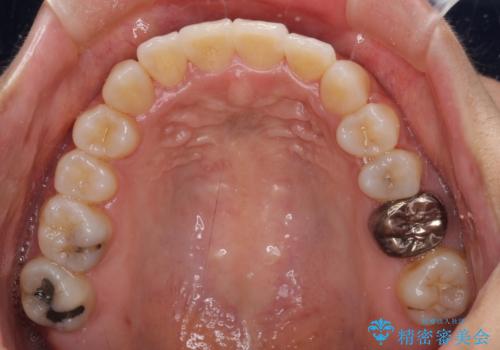 【モニター】幅の狭い上顎歯列 骨幅を拡大する矯正治療の治療後