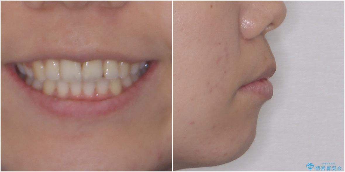 口元をスッキリと ワイヤー装置による抜歯矯正の治療後(顔貌)