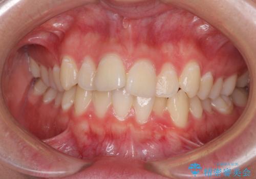 前歯のデコボコを改善　インビザライン矯正の治療前