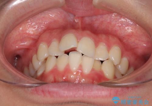 前歯のデコボコを改善　インビザライン矯正の治療前