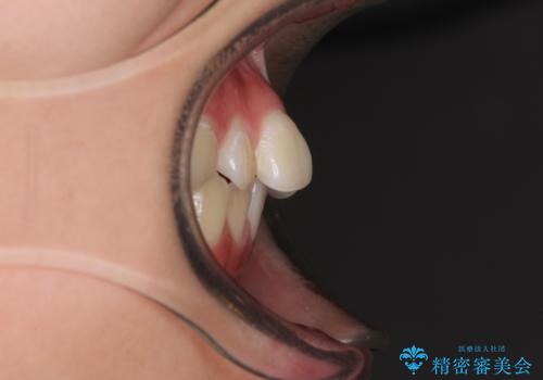 前歯のデコボコを改善 インビザライン矯正の治療前