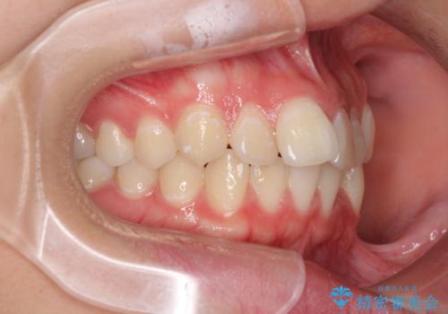 前歯のデコボコを改善 インビザライン矯正の治療前