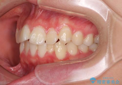 前歯のデコボコを改善 インビザライン矯正の治療前