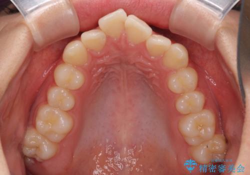 前歯のデコボコを改善 インビザライン矯正の治療前