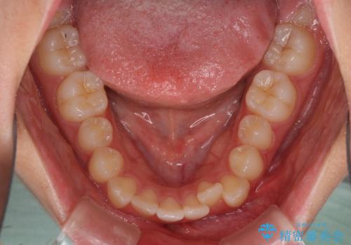 前歯のデコボコを改善 インビザライン矯正の治療前