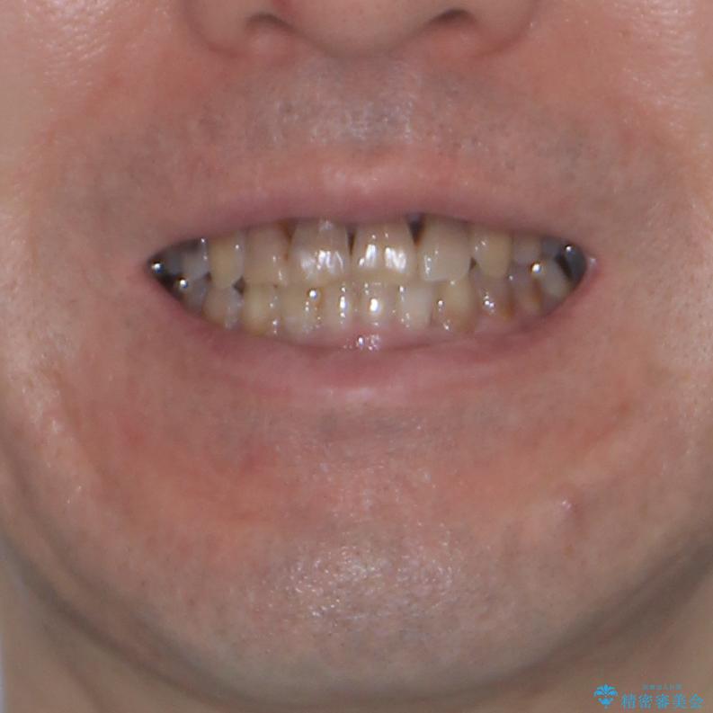 上顎の狭窄歯列　インビザラインによる拡大矯正の治療後（顔貌）
