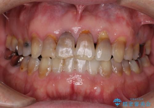 上顎の狭窄歯列 インビザラインによる拡大矯正の治療後