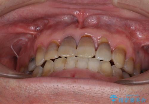 上顎の狭窄歯列　インビザラインによる拡大矯正の治療後