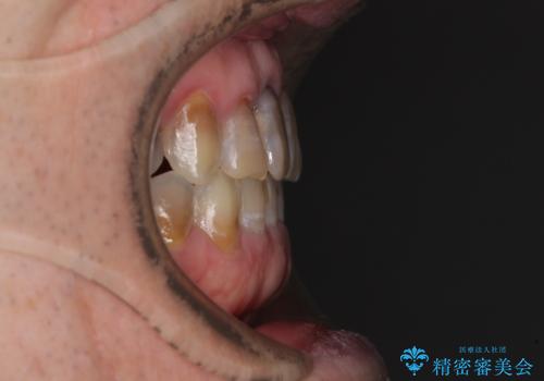 上顎の狭窄歯列 インビザラインによる拡大矯正の治療後