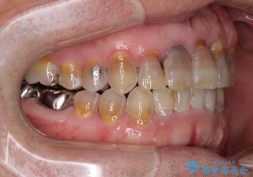 上顎の狭窄歯列 インビザラインによる拡大矯正の治療後