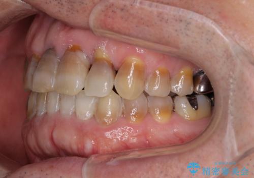 上顎の狭窄歯列 インビザラインによる拡大矯正の治療後