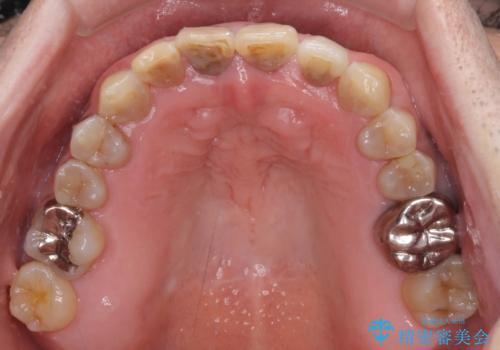 上顎の狭窄歯列 インビザラインによる拡大矯正の治療後