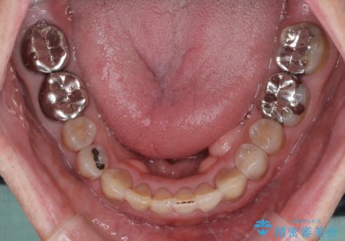 上顎の狭窄歯列　インビザラインによる拡大矯正の治療後