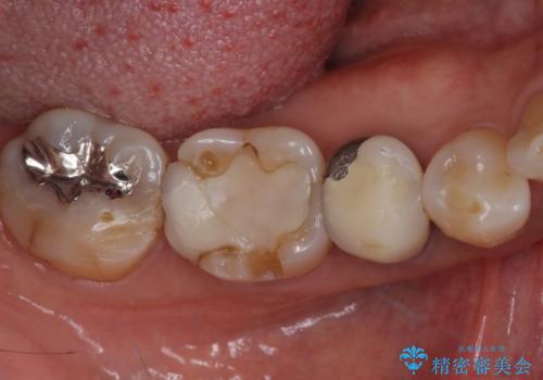欠けてしまった奥歯 セラミッククラウンによる補綴治療の治療前